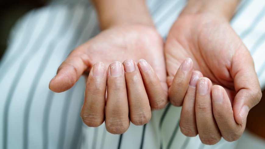 How to Prevent Dry & Brittle Nails in Canada’s Harsh Winter