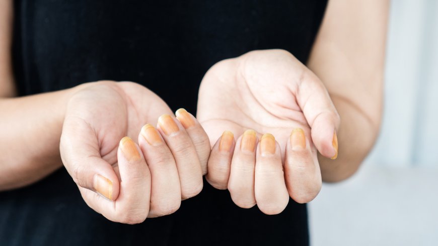 Prevent Nail Damage During Canada’s Harsh Winters – Expert Tips