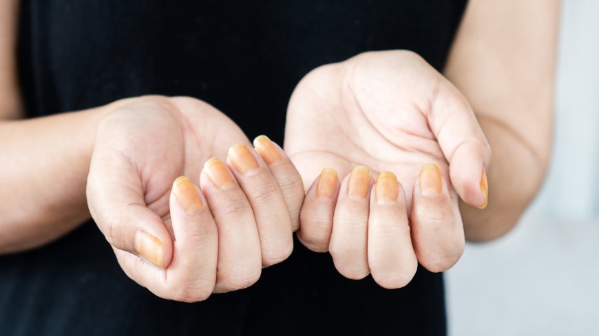 The Impact of Nail Health on Overall Wellness – What You Need to Know