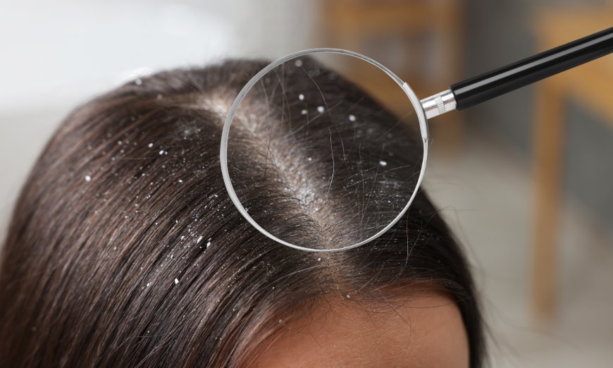 Summer Scalp Care Tips: How to Beat the Heat and Keep Hair Healthy
